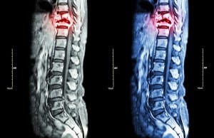  What Are the Levels of Spinal Cord Injury?