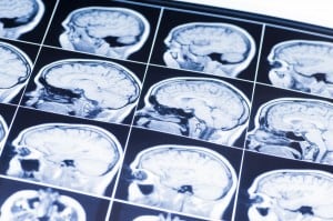 Causes and Consequences of Traumatic Brain Injury