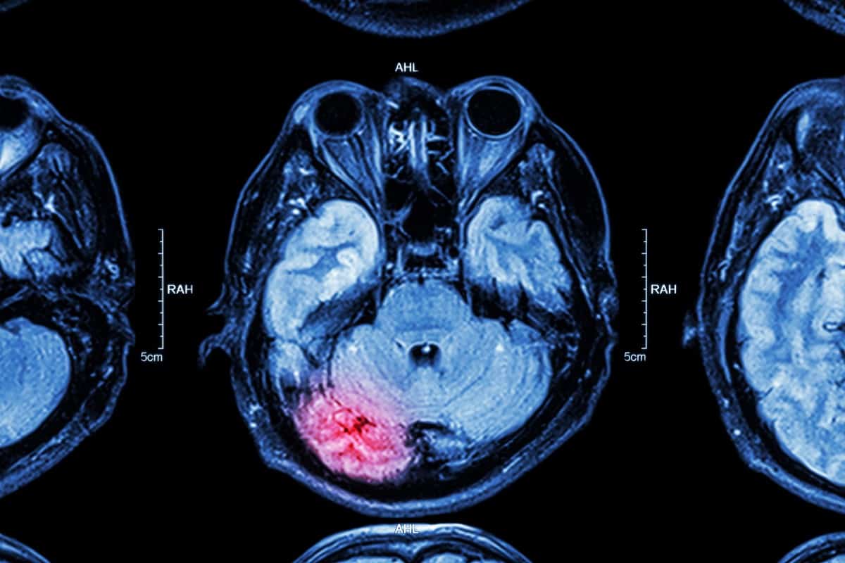 Do Brain Injuries Cause Personality Changes?